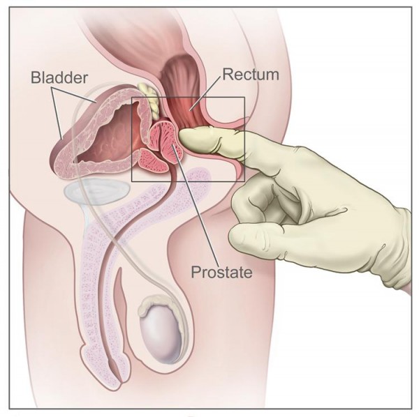 prostate cancer